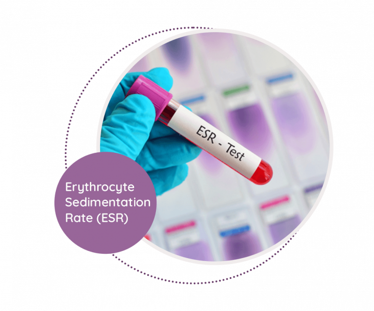 Erythrocyte Sedimentation Rate MediScan Lab erythrocyte-sedimentation-rate-mediscan-lab
