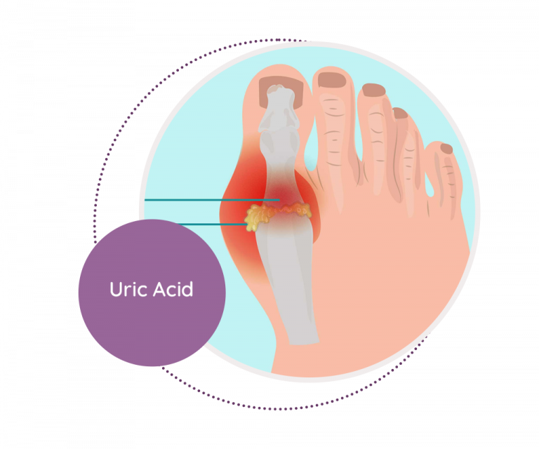 Uric Acid - MediScan Lab